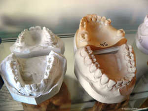 Gebissabdrücke aus Gips,Herstellung von,Zahnbrücke,Zahnersatz,Zahnkrone 